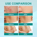 South Moon Medical Grade Scar Spray For Burns Surgery & Stretch Marks