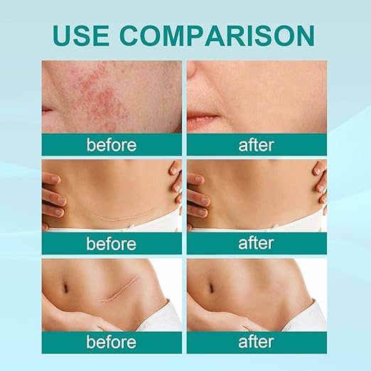 South Moon Medical Grade Scar Spray For Burns Surgery & Stretch Marks
