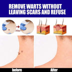 Fast Acting Warts Remover Liquid For Hands Feet & Face Maximum Strength